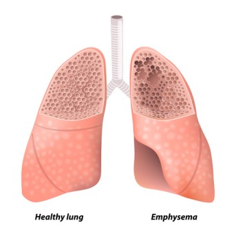 Lung Volume Reduction Surgery by OrangeCountySurgeons.org - 2